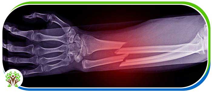 Bone Fracture Treatment Clinic Near Me Clinic in Palm Bay FL