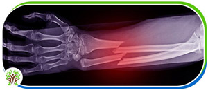 Bone Fracture Treatment Clinic Near Me Clinic in Palm Bay FL