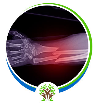 Broken Bones Treatment Near Me in Palm Bay, FL