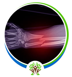 Broken Bones Treatment Near Me in Palm Bay, FL